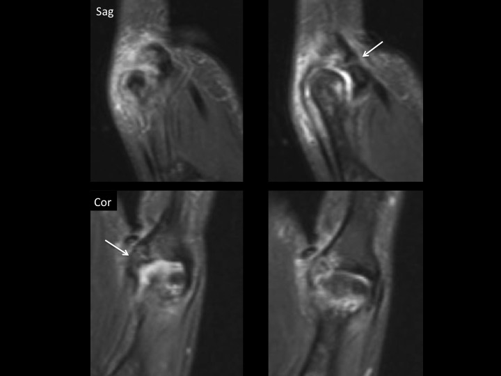 Figure 2 for case ulnar collateral ligament of metacarpophalangeal joint ( RID2336 )
